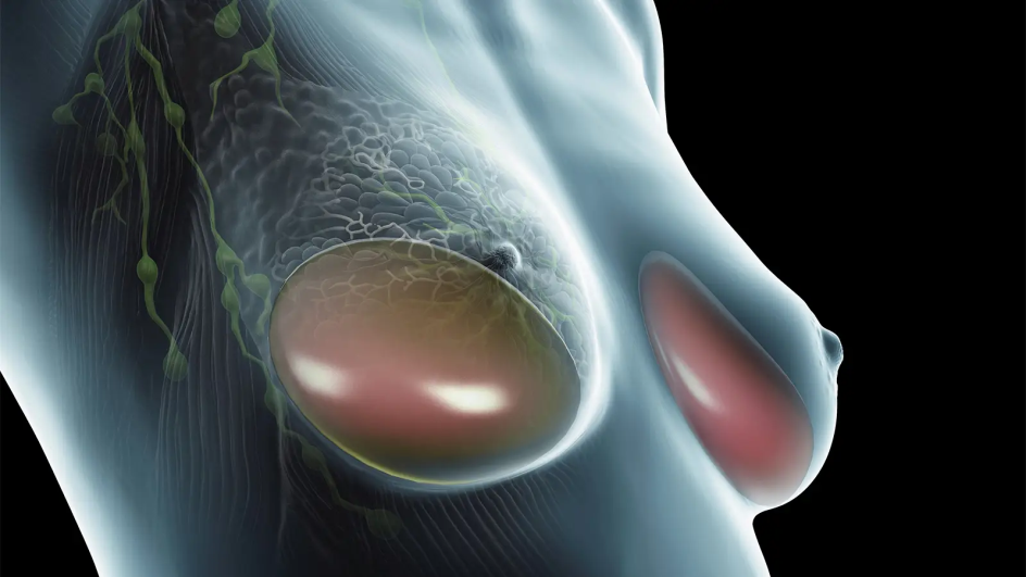 乳房植入物相關淋巴癌比報導的更常見
