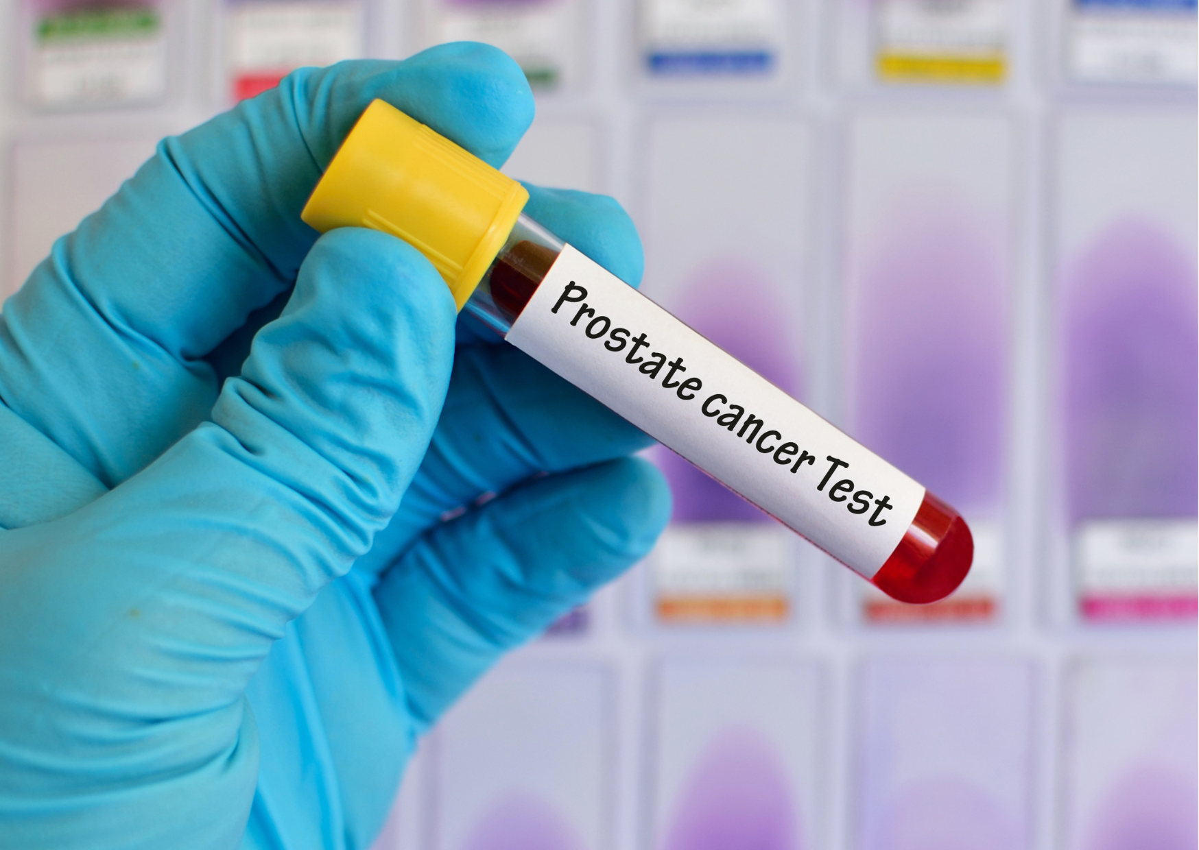 新的攝護腺癌血液檢測可結束偽陽性對男性的折磨