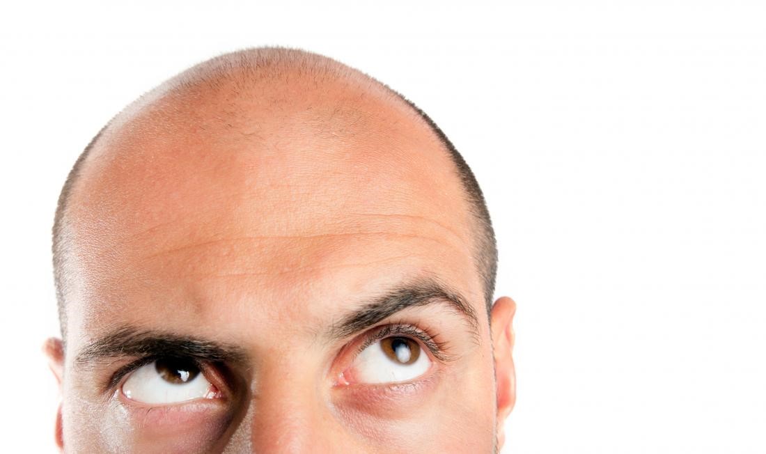 男性禿頭、灰髮比肥胖更具心臟病風險？！