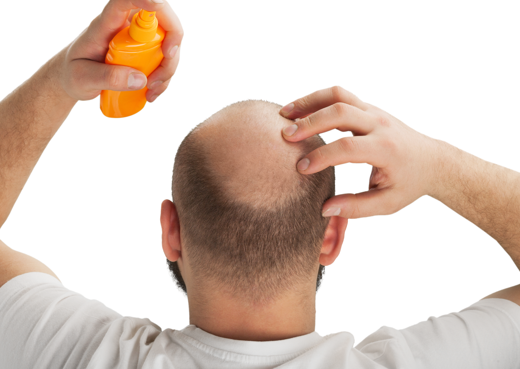 生髮藥的副作用會「永久」影響某些人