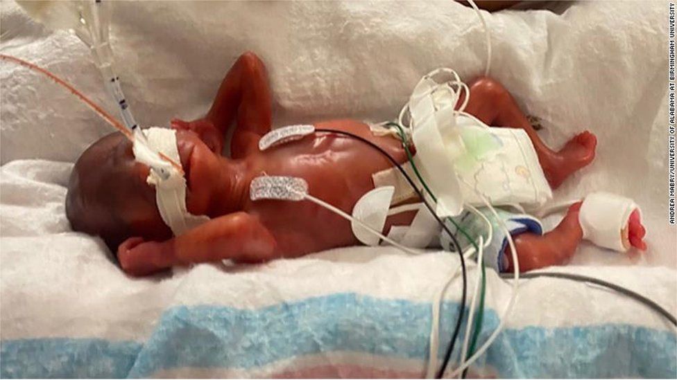 阿拉巴馬男孩被認證為世界上最早產兒