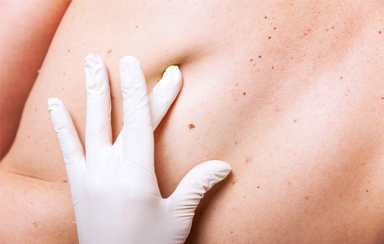 每天服用阿斯匹靈增加男性皮膚癌風險！